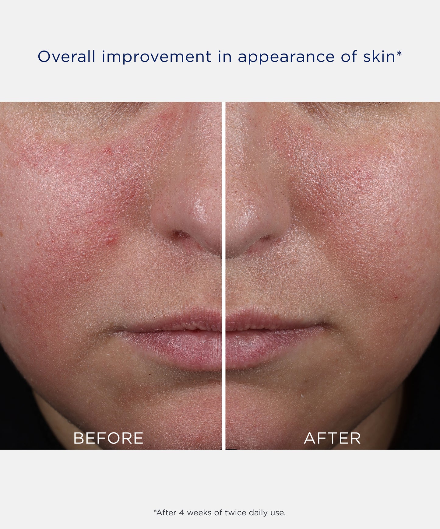 Before and after image side by side of a woman with dark brown hair showing overall improvement in skin after 4 weeks of twice daily use of NEOSTRATA Mandelic Clarifying Hydragel.