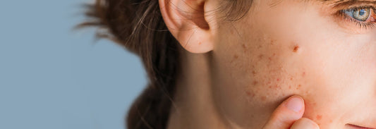 What Causes Adult Acne & Blemishes?